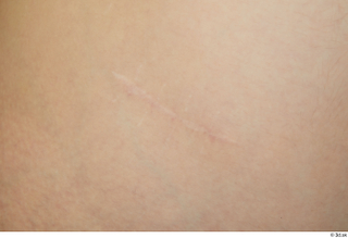 Vanessa Shelby scar skin 0001.jpg